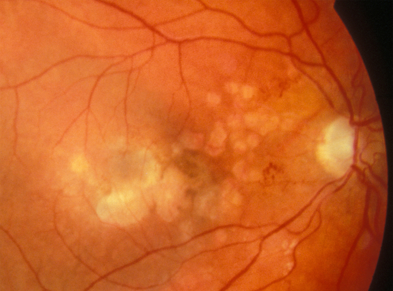 Retinal Capillary non-perfusion