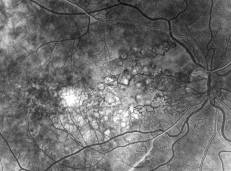 Retinal capillary nonperfusion
