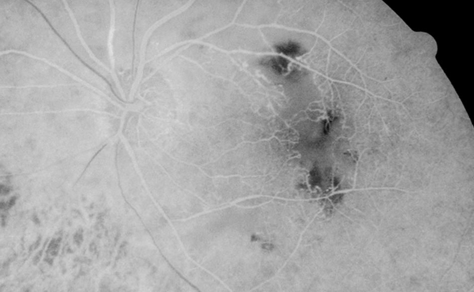 Retinal capillary nonperfusion