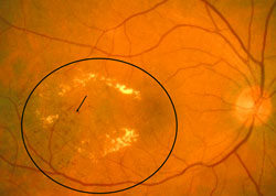 Microaneurysm