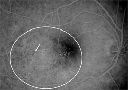 Microaneurysm