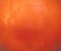 Vitreous Hemorrhage