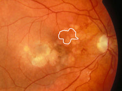 Capillary nonperfusion, mild
