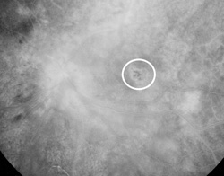 Foveal geographic atropht of the retinal pigment epithelium