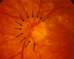 Optic disc edema