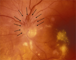 Optic disc edema