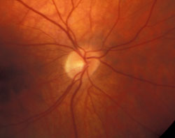 Optic disc hyperfluorescence, photo