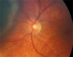 Optic disc hyperfluorescence, photo