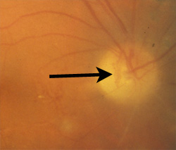 Neovascularixation of the disc
