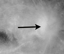 Neovascularixation of the disc