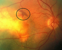 Mild Subretinal hemorrhage