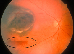 Moderate Subretinal hemorrhage
