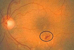 retinal hemorrhage, mild