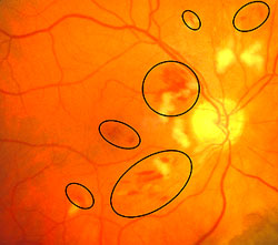 retinal hemorrhage, moderate