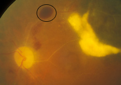 Preretinal hemorrhage, mild