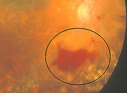 Preretinal hemorrhage, moderate