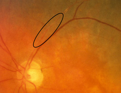 Perivascular sheathing
