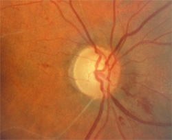 Optic disc pallor, after