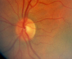 Optic disc pallor, after