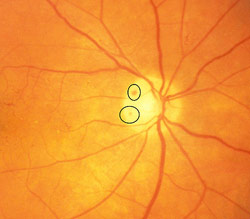 Optic disc hemorrhage, mild