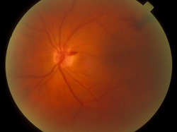 Optic disc hemorrhage, moderate