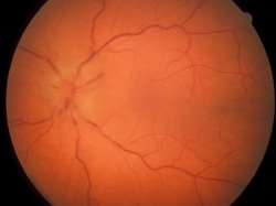 Optic disc hemorrhage, severe