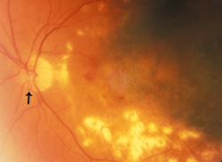 Optic disc hemorrhage, severe