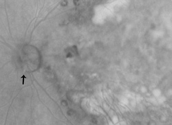Optic disc hemorrhage, severe, angiogram