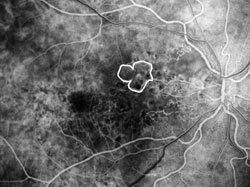 Capillary nonperfusion, mild, early angiogram