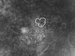 Capillary nonperfusion, mild, late angiogram