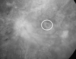 Foveal geographic atropht of the retinal pigment epithelium