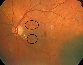 Mild Telangiectasia