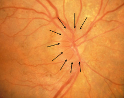 Optic disc edema
