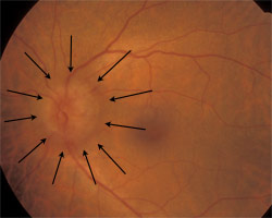 Optic disc edema