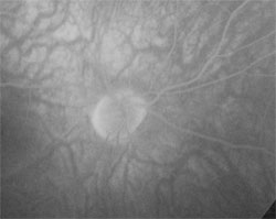Optic disc hyperfluorescence, angiogram
