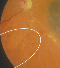 Moderate Telangiectasia