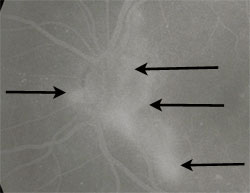 Neovascularixation of the disc