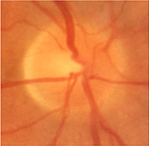 Fundus photo showing large cup to disc asymmetry