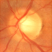 Fundus photo showing large cup to disc asymmetry