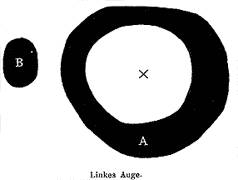 Example of Von Graefe's Figures in his classic article: "Examination of the Visual Functions in Amblyopic Affections."