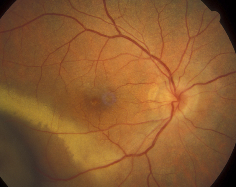 Retinal Vascular LEakage of the macula