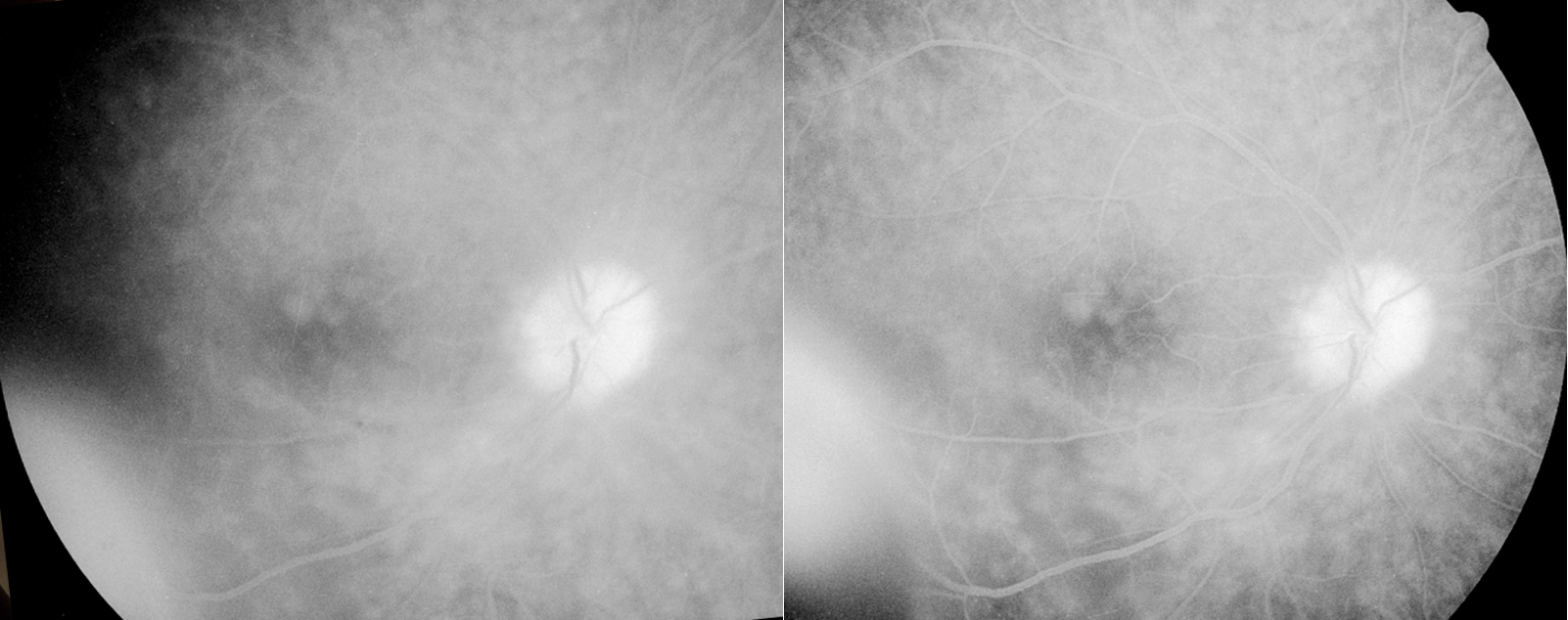 Retinal Vascular Leakage of the macula