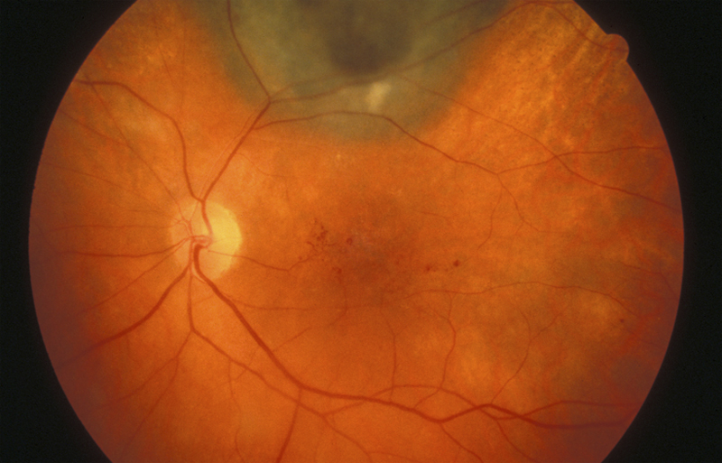 Retinal Vascular Leakage of the macula