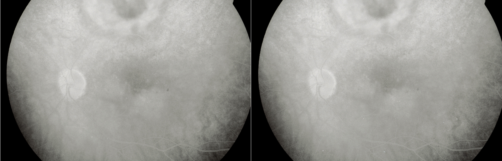 Retinal Vascular LEakage of the macula