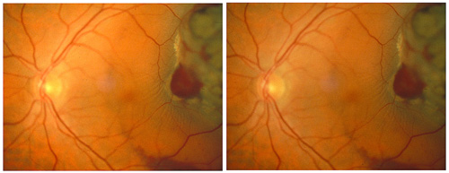 Stereo pair of retinal detachment involving the fovea