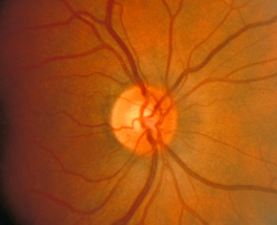 Optic disc pallor, before