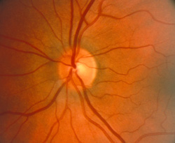 Optic disc pallor,before