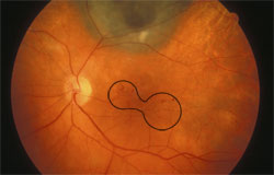 Retinal vascular leakage of the macula, moderate