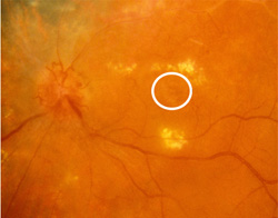 Foveal geographic atropht of the retinal pigment epithelium