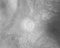 Optic disc hyperfluorescence, angiogram